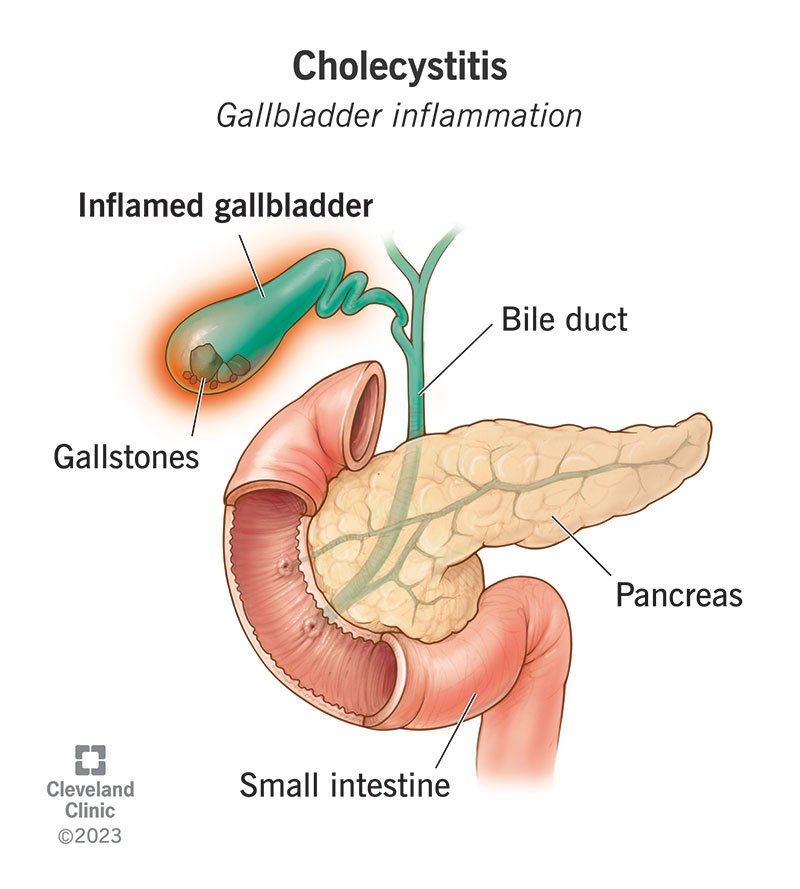 Pain of Cholecystitis