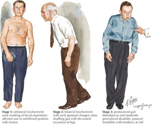 Feel the MEDICINE | Neurology | Gait apraxia